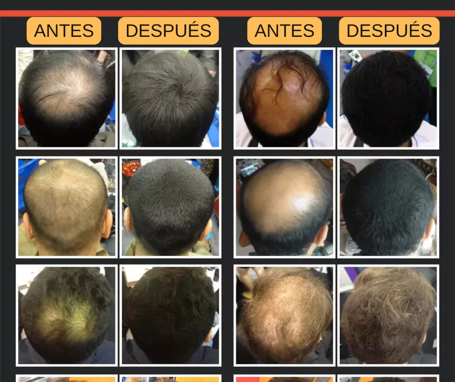 Fibra Capilar Dexe: Oculta la Pérdida de Cabello al Instante